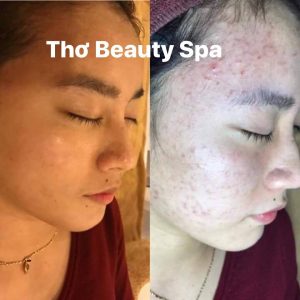 Điều trị mụn