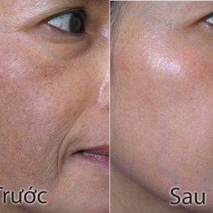 Điều trị nám (nám mảng, nám chân sâu, nám máu)
