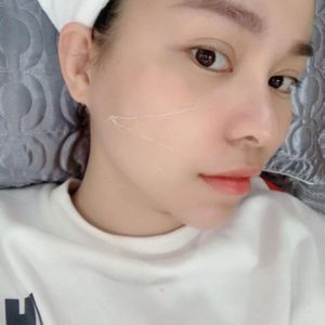Cấy chỉ Nano kim cương