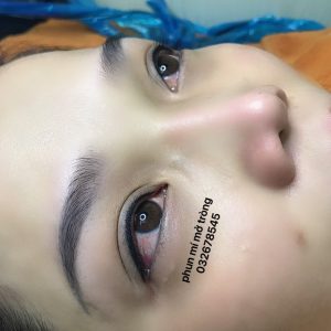Phun mí mở tròng (mí trên)