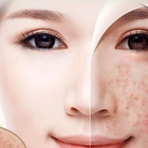 Điều trị nám chuyên sâu (nám chân đinh)