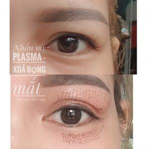 Công nghệ xoá nhăn Plasma Fribroblast