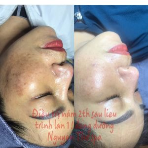 Điều trị nám cao cấp chỉ từ 7999k